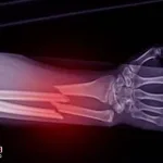 Skin-creams-can-cause-bone-fractures.-New-research