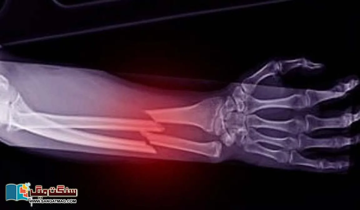 Skin-creams-can-cause-bone-fractures.-New-research