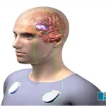brain-pacemaker-depression