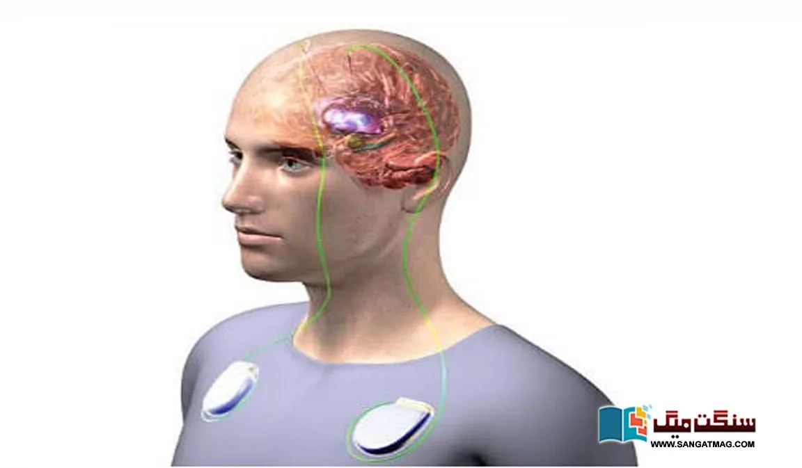 brain-pacemaker-depression