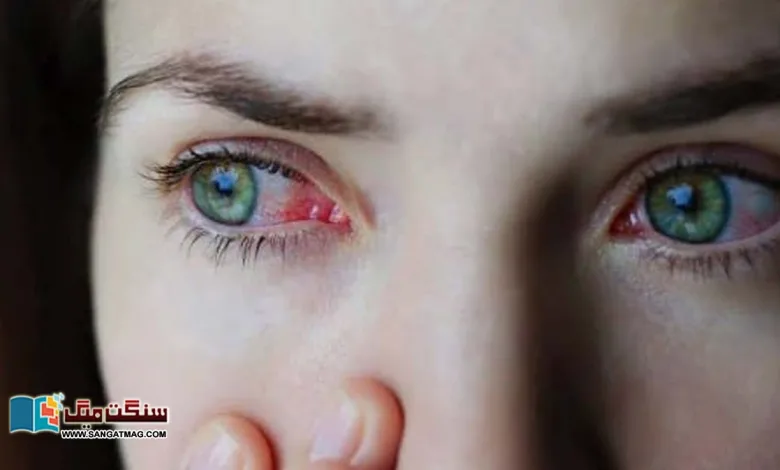 Eye-infections-can-be-more-serious-than-you-realize.-Experts-warn