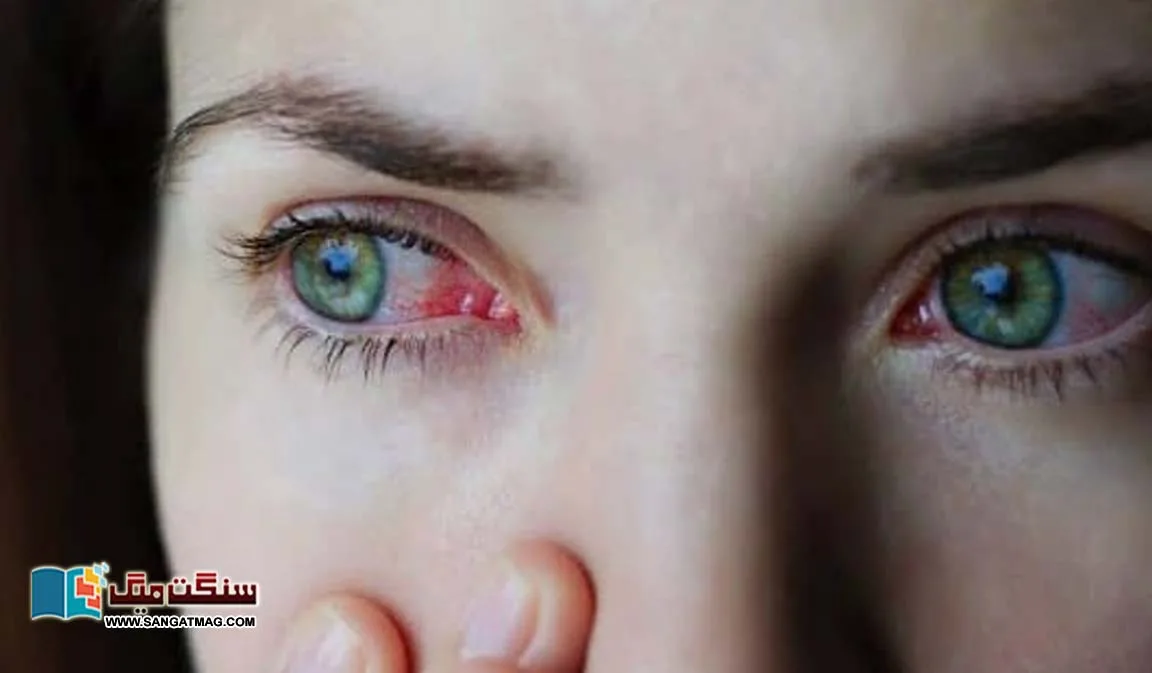 Eye-infections-can-be-more-serious-than-you-realize.-Experts-warn